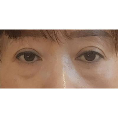 눈밑처짐 수술 2주차, 너무 맘에 들어서 거울만 봐요 사진 2 — 아바성형외과 눈밑지방재배치 후기
