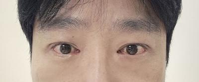 쌍꺼풀 절개 8주차, 원했던 얇은 인라인 그대로 나왔어요 — 아바성형외과 환자 후기 사진