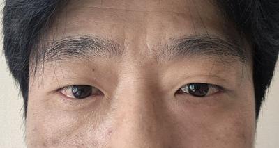 쌍꺼풀 절개 8주차, 원했던 얇은 인라인 그대로 나왔어요 사진 2 — 아바성형외과 쌍꺼풀·눈성형 후기