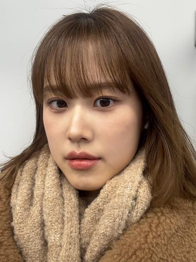 눈밑지방재배치 6주차, 붓기 다 빠지고 티 하나도 안 나요 — 아바성형외과 환자 후기 사진