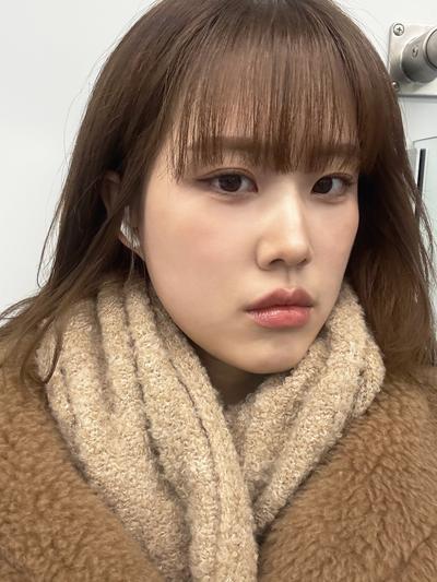 눈밑지방재배치 6주차, 붓기 다 빠지고 티 하나도 안 나요 사진 5 — 아바성형외과 눈밑지방재배치 후기