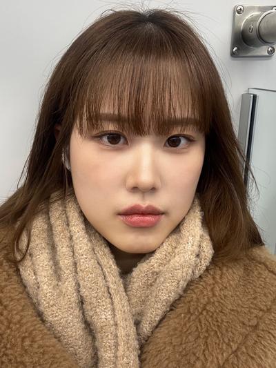 눈밑지방재배치 6주차, 붓기 다 빠지고 티 하나도 안 나요 사진 6 — 아바성형외과 눈밑지방재배치 후기