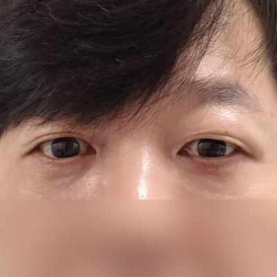 눈성형 환자 후기 — 눈밑지 시술한지 6주가넘었네... (144)