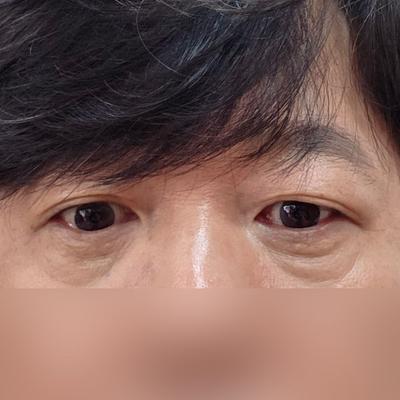 눈밑지방재배치 6주차, 처음보다 훨씬 좋아졌어요 사진 2 — 아바성형외과 눈밑지방재배치 후기