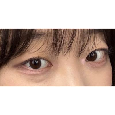 아바성형외과 김승수 원장님 수술 6주차, 아주 만족합니다 사진 2 — 아바성형외과 기타 후기