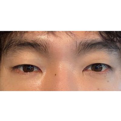 수술 2주차 사진, 붓기 더 빠지길 기다리는 중이에요 — 아바성형외과 환자 후기 사진