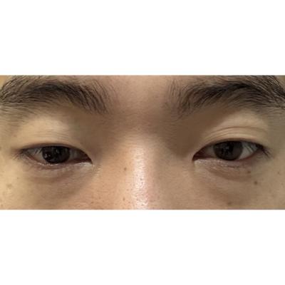수술 2주차 사진, 붓기 더 빠지길 기다리는 중이에요 사진 2 — 아바성형외과 기타 후기