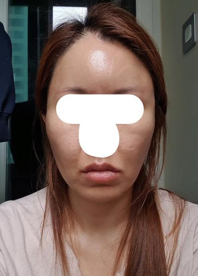 이중턱 앞볼 지방흡입에 실리프팅까지, 턱선 라인이 살아났어요 사진 2 — 아바성형외과 안면거상 후기