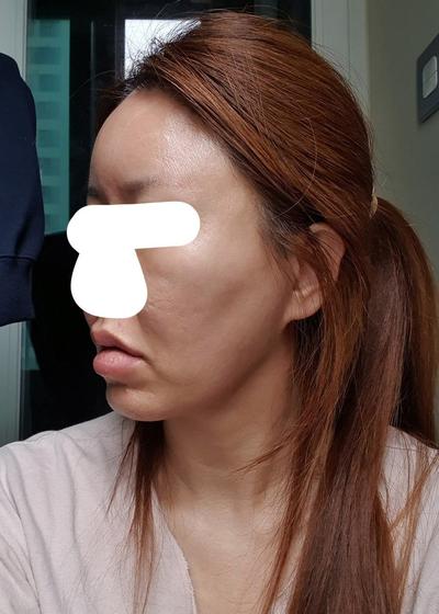 이중턱 앞볼 지방흡입에 실리프팅까지, 턱선 라인이 살아났어요 사진 4 — 아바성형외과 안면거상 후기