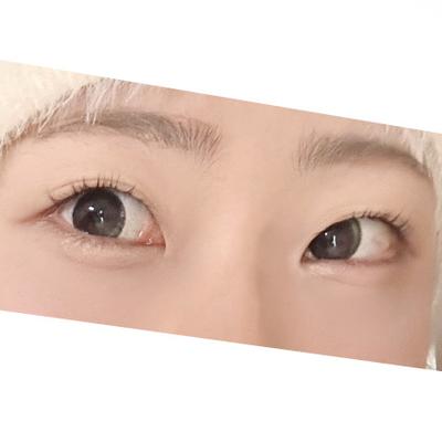 눈밑지방재배치 8주차, 안색 좋아지고 진작 할 걸 싶어요 — 아바성형외과 환자 후기 사진