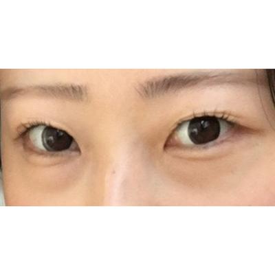 눈밑지방재배치 8주차, 안색 좋아지고 진작 할 걸 싶어요 사진 2 — 아바성형외과 눈밑지방재배치 후기