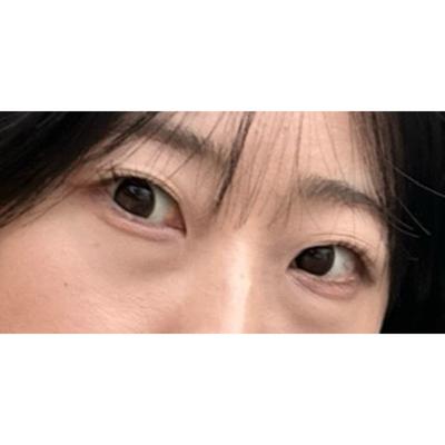 눈밑지방재배치 8주차, 안색 좋아지고 진작 할 걸 싶어요 사진 3 — 아바성형외과 눈밑지방재배치 후기
