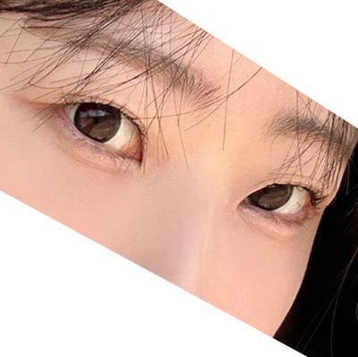 눈밑지방재배치 8주차, 안색 좋아지고 진작 할 걸 싶어요 사진 4 — 아바성형외과 눈밑지방재배치 후기