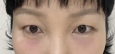 눈밑지방재배치 3주차, 진작 할 걸 그랬어요 퀭한 느낌 사라짐 — 아바성형외과 환자 후기 사진