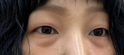 눈밑지방재배치 3주차, 진작 할 걸 그랬어요 퀭한 느낌 사라짐 사진 3 — 아바성형외과 눈밑지방재배치 후기