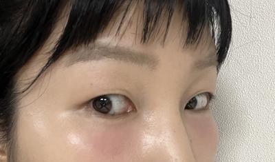 눈밑지방재배치 3주차, 진작 할 걸 그랬어요 퀭한 느낌 사라짐 사진 4 — 아바성형외과 눈밑지방재배치 후기