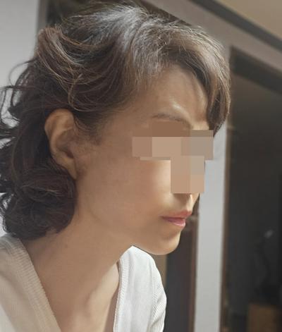 안면거상 16주차, 흉터도 안 보이고 10년은 젊어 보여요 — 아바성형외과 환자 후기 사진