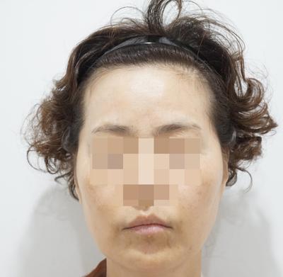 안면거상 16주차, 흉터도 안 보이고 10년은 젊어 보여요 사진 3 — 아바성형외과 안면거상 후기