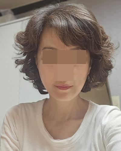 안면거상 16주차, 흉터도 안 보이고 10년은 젊어 보여요 사진 4 — 아바성형외과 안면거상 후기