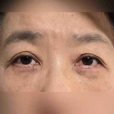 하안검·눈밑지방재배치 4주차, 눈 커지고 뜨는 게 편해졌어요 — 아바성형외과 환자 후기 사진
