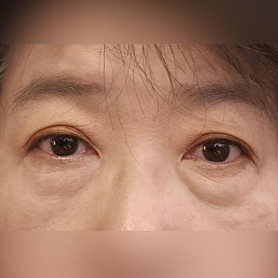 하안검·눈밑지방재배치 4주차, 눈 커지고 뜨는 게 편해졌어요 사진 2 — 아바성형외과 눈밑지방재배치 후기