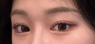 눈밑지＋쌍수＋광대축소 5주차, 지금이 너무너무 마음에 들어요 — 아바성형외과 환자 후기 사진