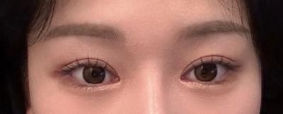 눈밑지＋쌍수＋광대축소 5주차, 지금이 너무너무 마음에 들어요 사진 3 — 아바성형외과 눈밑지방재배치 후기