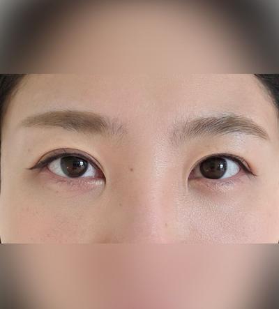 눈밑지방재배치＋지방이식 8주차, 인상 밝아졌다는 말 진짜 많이 들어요 — 아바성형외과 환자 후기 사진