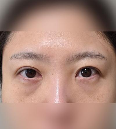눈밑지방재배치＋지방이식 8주차, 인상 밝아졌다는 말 진짜 많이 들어요 사진 2 — 아바성형외과 눈밑지방재배치 후기
