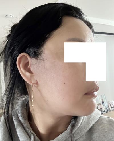 미간·팔자주름 개선 후기, 중년 주름 고민이면 진짜 추천 — 아바성형외과 환자 후기 사진
