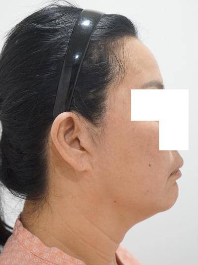 미간·팔자주름 개선 후기, 중년 주름 고민이면 진짜 추천 사진 2 — 아바성형외과 기타 후기
