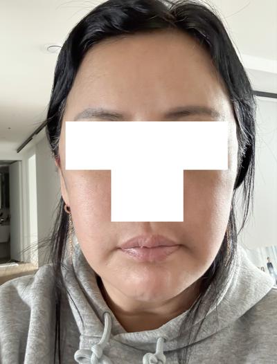 미간·팔자주름 개선 후기, 중년 주름 고민이면 진짜 추천 사진 4 — 아바성형외과 기타 후기
