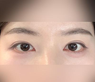 눈밑지방재배치 4주차, 아무도 수술한 줄 몰라요 — 아바성형외과 환자 후기 사진