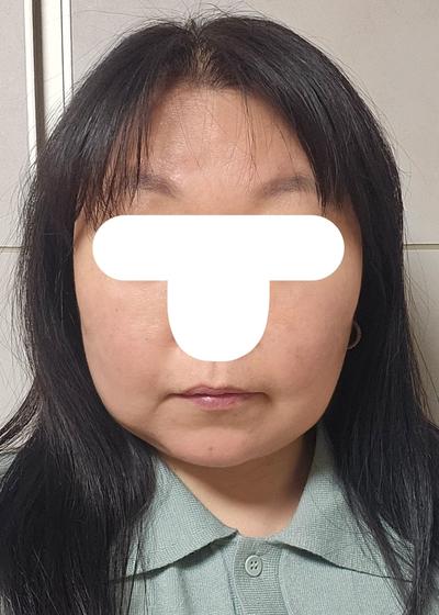 눈수술 6주차, 3일 만에 일상복귀하고 거울 보는 재미가 — 아바성형외과 환자 후기 사진