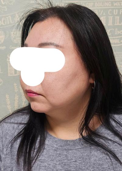 눈수술 6주차, 3일 만에 일상복귀하고 거울 보는 재미가 사진 2 — 아바성형외과 쌍꺼풀·눈성형 후기