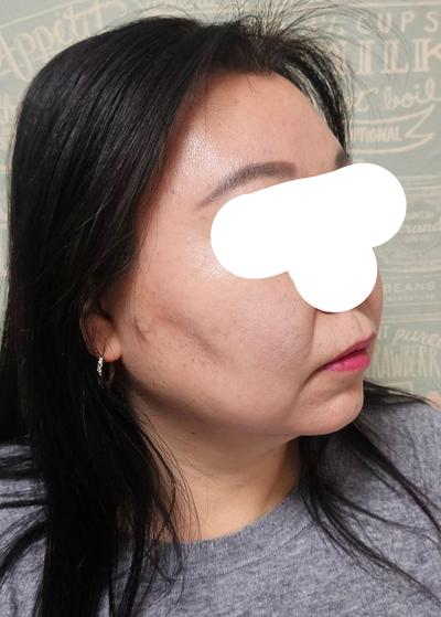 눈수술 6주차, 3일 만에 일상복귀하고 거울 보는 재미가 사진 3 — 아바성형외과 쌍꺼풀·눈성형 후기