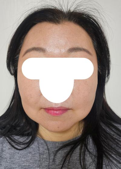 눈수술 6주차, 3일 만에 일상복귀하고 거울 보는 재미가 사진 4 — 아바성형외과 쌍꺼풀·눈성형 후기