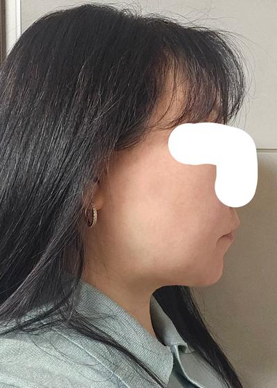 눈수술 6주차, 3일 만에 일상복귀하고 거울 보는 재미가 사진 5 — 아바성형외과 쌍꺼풀·눈성형 후기