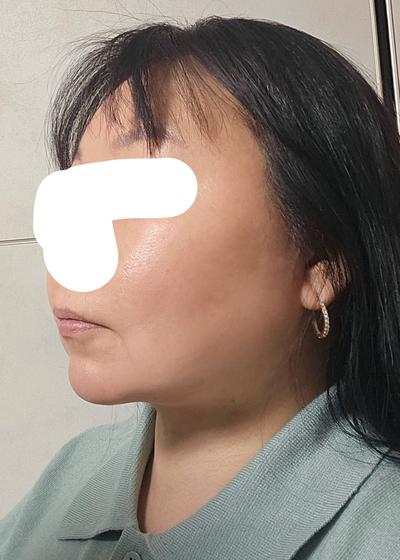 눈수술 6주차, 3일 만에 일상복귀하고 거울 보는 재미가 사진 6 — 아바성형외과 쌍꺼풀·눈성형 후기
