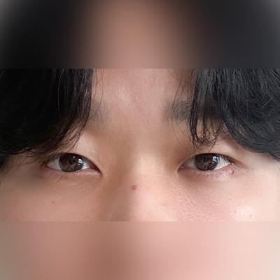 눈밑 수술 4주차, 자연스럽게 잘 됐다는 말 들어요 — 아바성형외과 환자 후기 사진