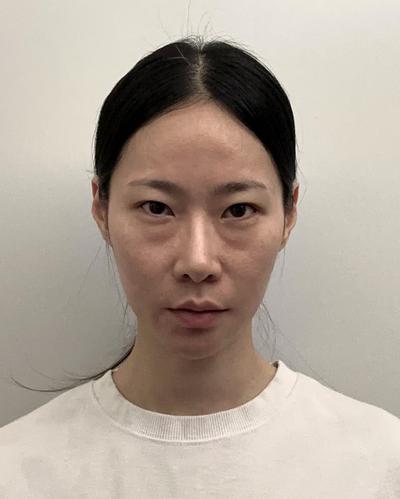 눈밑지방재배치 6주차, 제 수술 중 만족도 탑3에 들어요 사진 3 — 아바성형외과 눈밑지방재배치 후기
