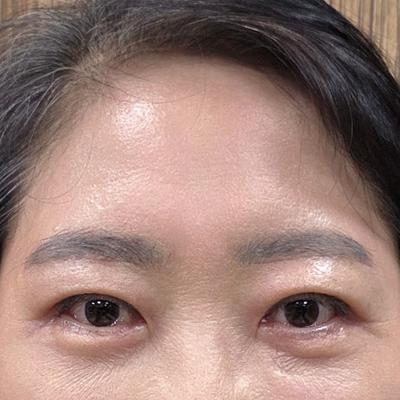 이마거상 8주차, 이마 매끈해지고 인상까지 밝아졌어요 — 아바성형외과 환자 후기 사진
