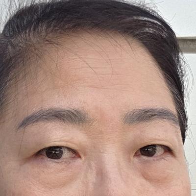 이마거상 8주차, 이마 매끈해지고 인상까지 밝아졌어요 사진 2 — 아바성형외과 안면거상 후기