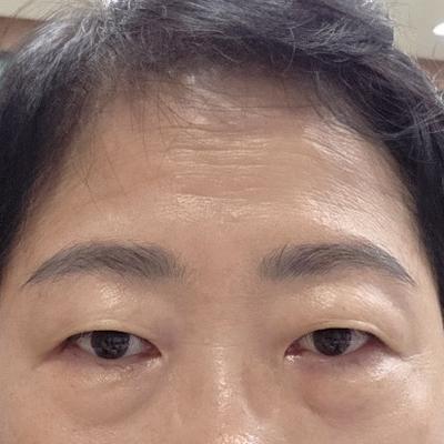 이마거상 8주차, 이마 매끈해지고 인상까지 밝아졌어요 사진 3 — 아바성형외과 안면거상 후기