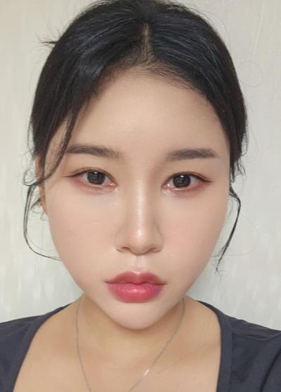 눈밑지방재배치 2주차, 꺼진 눈밑이 많이 정돈됐어요 — 아바성형외과 환자 후기 사진