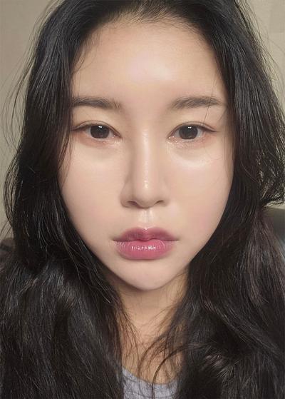 눈밑지방재배치 2주차, 꺼진 눈밑이 많이 정돈됐어요 사진 2 — 아바성형외과 눈밑지방재배치 후기