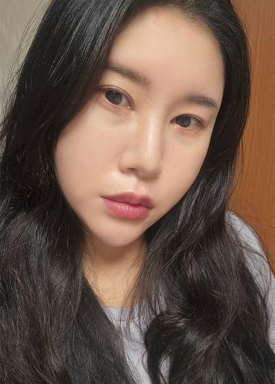 눈밑지방재배치 2주차, 꺼진 눈밑이 많이 정돈됐어요 사진 3 — 아바성형외과 눈밑지방재배치 후기