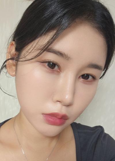 눈밑지방재배치 2주차, 꺼진 눈밑이 많이 정돈됐어요 사진 4 — 아바성형외과 눈밑지방재배치 후기