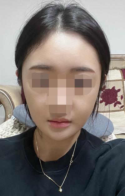 안면거상 환자 후기 — ⭐️브라운성형외과⭐️
⭐️김... (162)