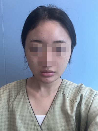 얼굴지방흡입 이중턱 7주차, 살 빠졌냐는 말 계속 들어요 사진 2 — 아바성형외과 이중턱·윤곽 후기